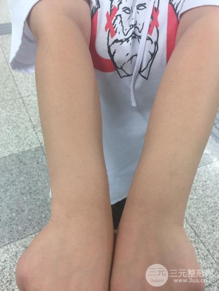 空军总医院激光脱毛半个月