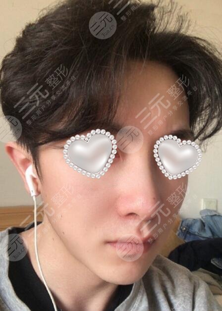 男生隆鼻前后对比