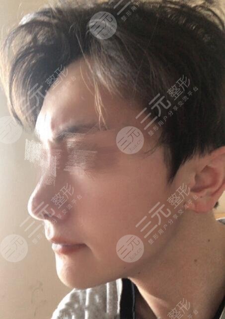 男生隆鼻前后对比