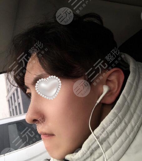 男生隆鼻前后对比