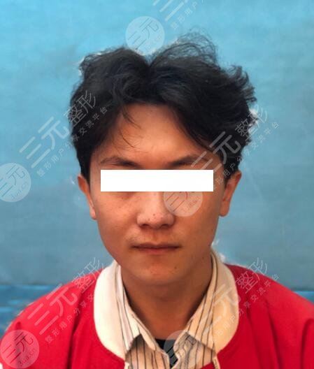 男生隆鼻前后对比