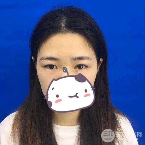 双眼皮整形案例