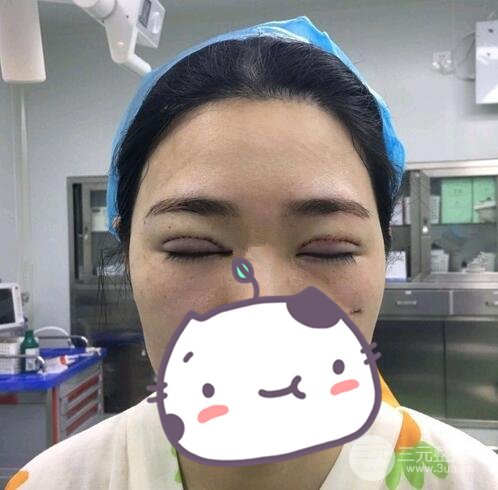 双眼皮整形案例