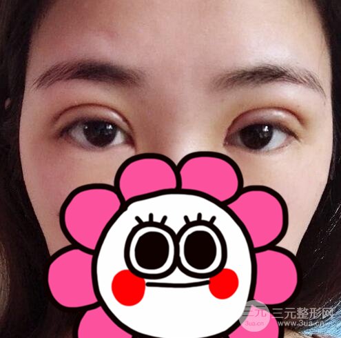 双眼皮整形案例
