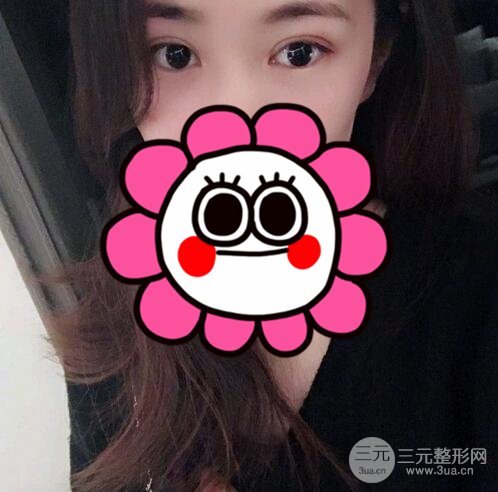 双眼皮整形案例