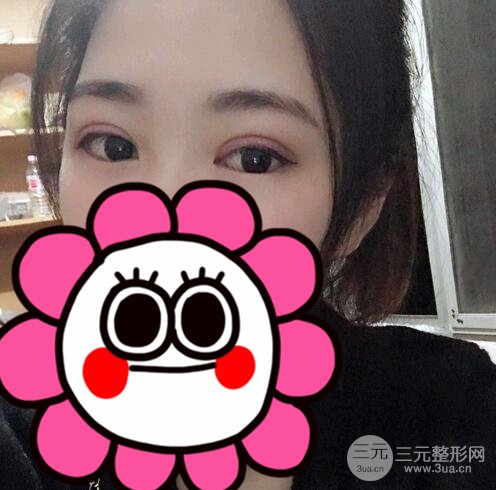 双眼皮整形案例