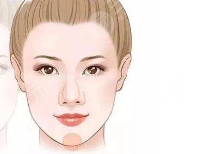 苹果肌自体脂肪填充前后对比果图片 真人日记分享