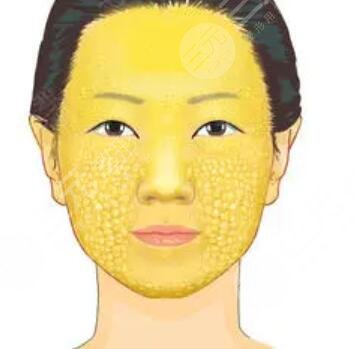 苹果肌自体脂肪填充前后对比果图片 真人日记分享