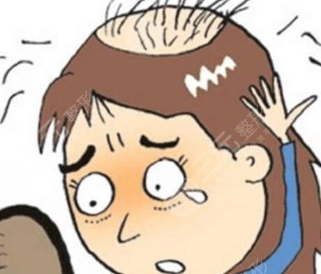 云南省一人民医院脱发治疗