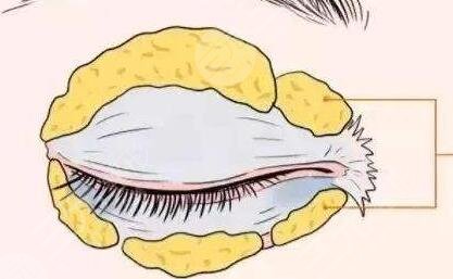 成都刘辅容双眼皮修复到底怎么样？和大家分享一波刘辅容眼修复案例