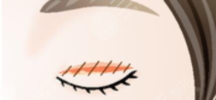 沈阳百嘉丽和杏林做双眼皮哪个好