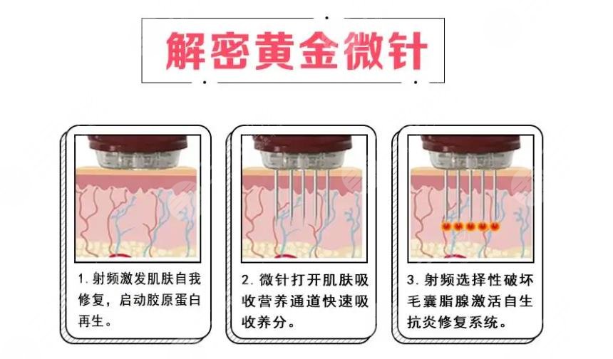黄金微针为什么好多人做了没效果？原理、禁忌症等盘点！术前避雷~