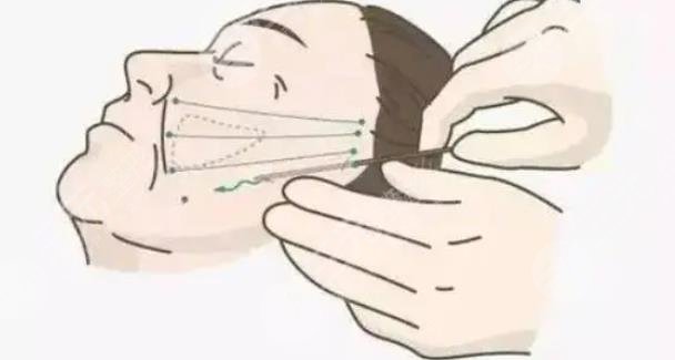 面部拉皮手术能维持几年