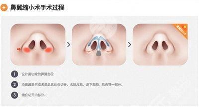 鼻翼缩小手术可能有哪些后遗症