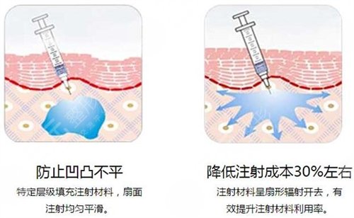 瑞兰玻尿酸注射除皱能保持多久?-城市惠