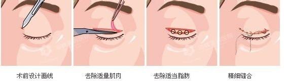 内双怎么变成双眼皮-城市惠