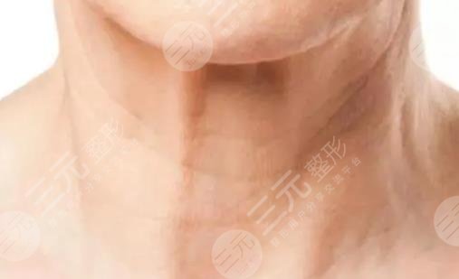 去颈纹