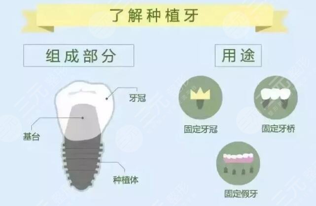 做种植牙的优点