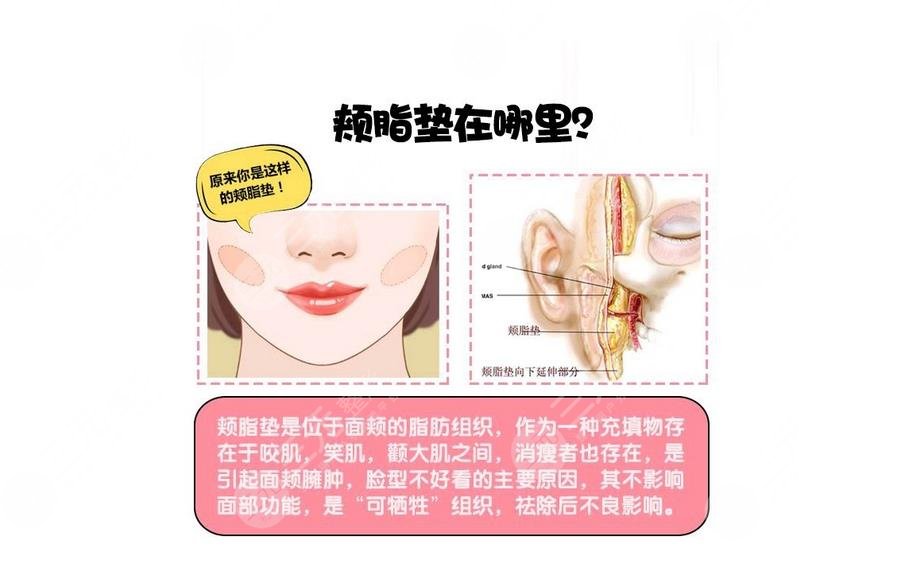 1,颊脂垫在哪个部位颊脂垫的位置在脸颊部位,每个人都会有这种情况,和