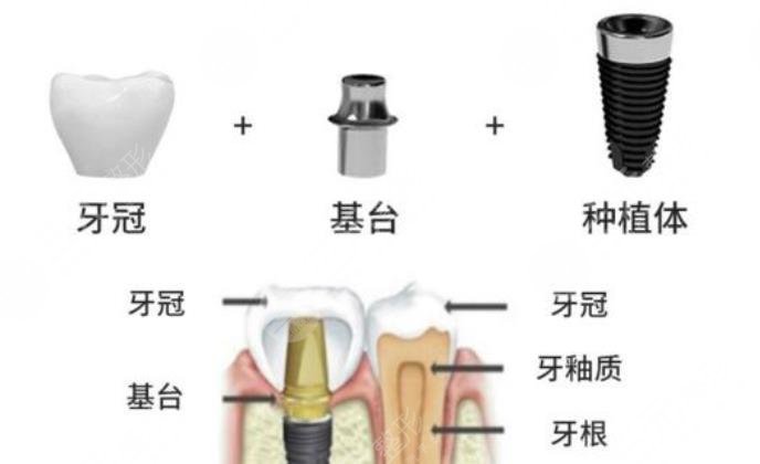 种植牙价格:一颗牙齿的重生