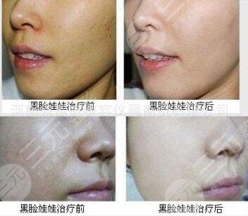 黑脸娃娃做完后都有哪些常见问题呢?