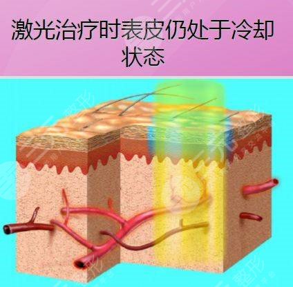 595染料激光多少钱
