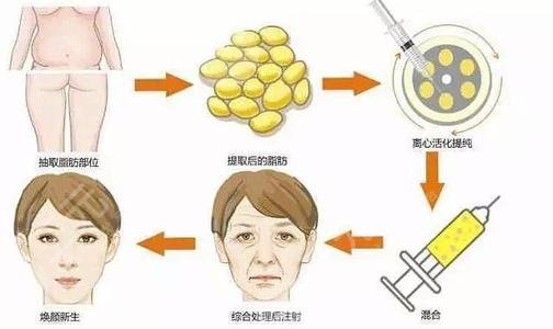 脂肪填充太阳凹陷能维持多久