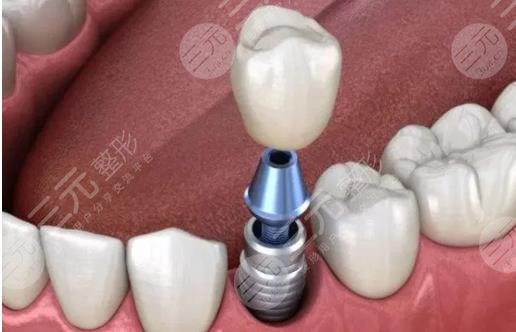 美国种植牙品牌
