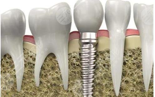 美国种植牙品牌