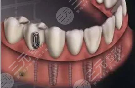 美国种植牙品牌