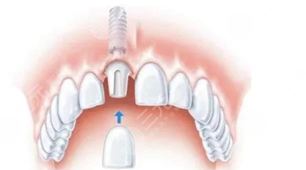 美国种植牙品牌