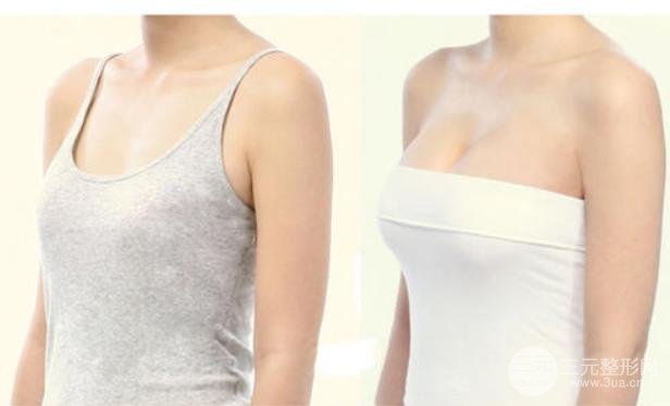 娜高隆胸能用一辈子吗？做假体隆胸需要定期更换假体？