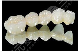 金钯烤瓷牙优缺点