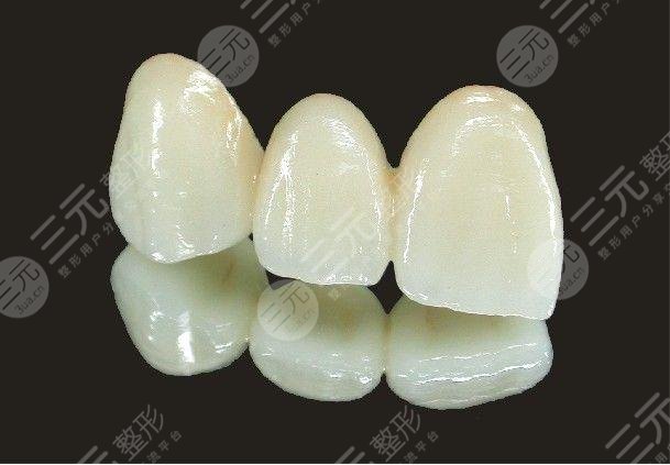 金钯烤瓷牙优缺点