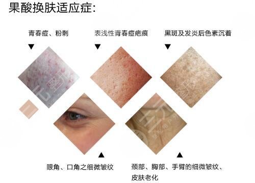 果酸焕肤多少钱