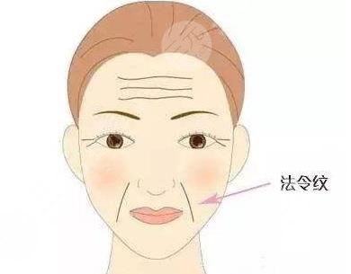 玻尿酸填充法令纹能保持多久