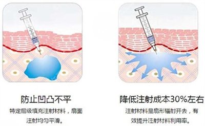 玻尿酸填充法令纹能保持多久