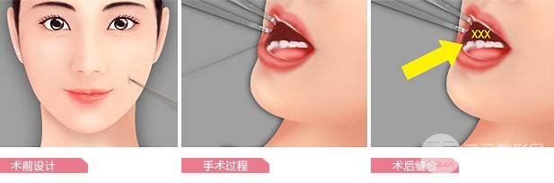[术前攻略]酒窝整形价格是多少，甜美女生必得~-城市惠整形