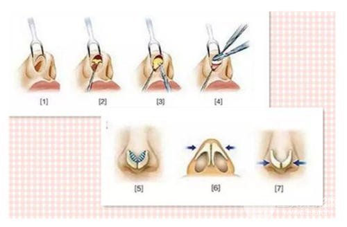 【解密】鼻头缩小手术后遗症与什么有关?这几点要牢记!