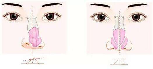 【解密】鼻头缩小手术后遗症与什么有关?这几点要牢记!