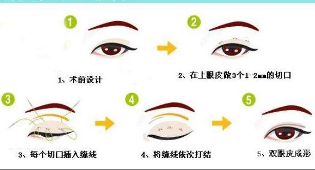 三点定位双眼皮