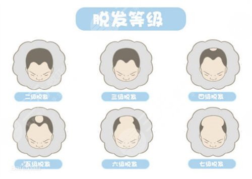 植发2000单位果图