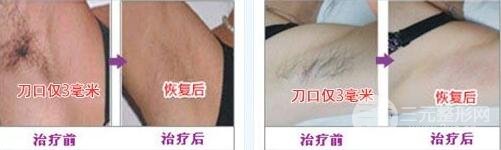 狐臭能被治愈吗?狐臭喜欢的治疗方法？狐臭手术后会不会留疤痕?