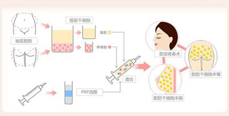 自体脂肪填充面部副作用有吗