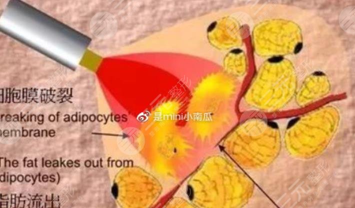 5g天使光雕吸脂