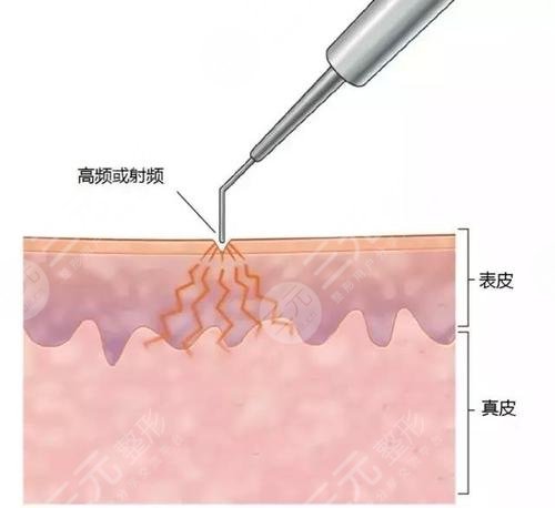 激光点痣的注意事项盘点