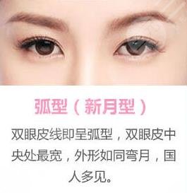新月型双眼皮