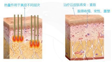 射频美容仪的作用原理是什么:MaryFairy宇石科技