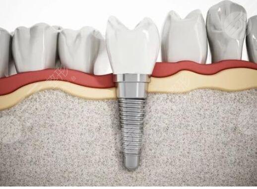 正规医院种植牙收费标准2024