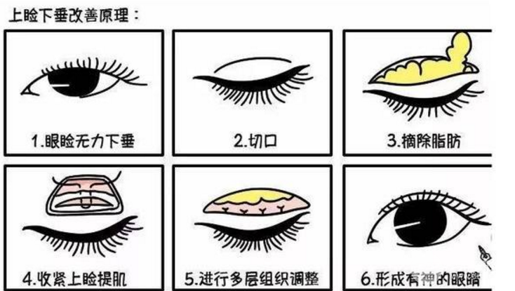 盘点那些年你错过的眼皮松弛手术恢复图片
